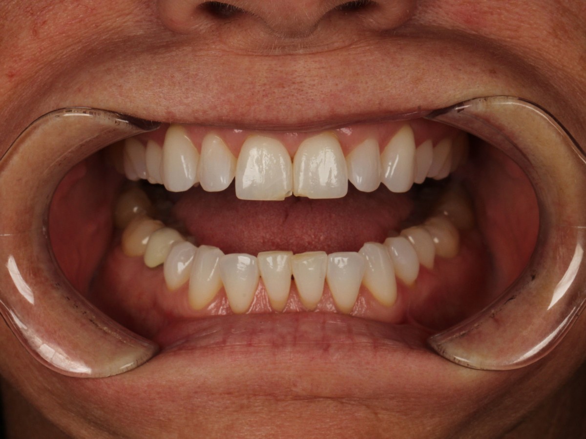 Full Mouth Rehabilitation before treatment