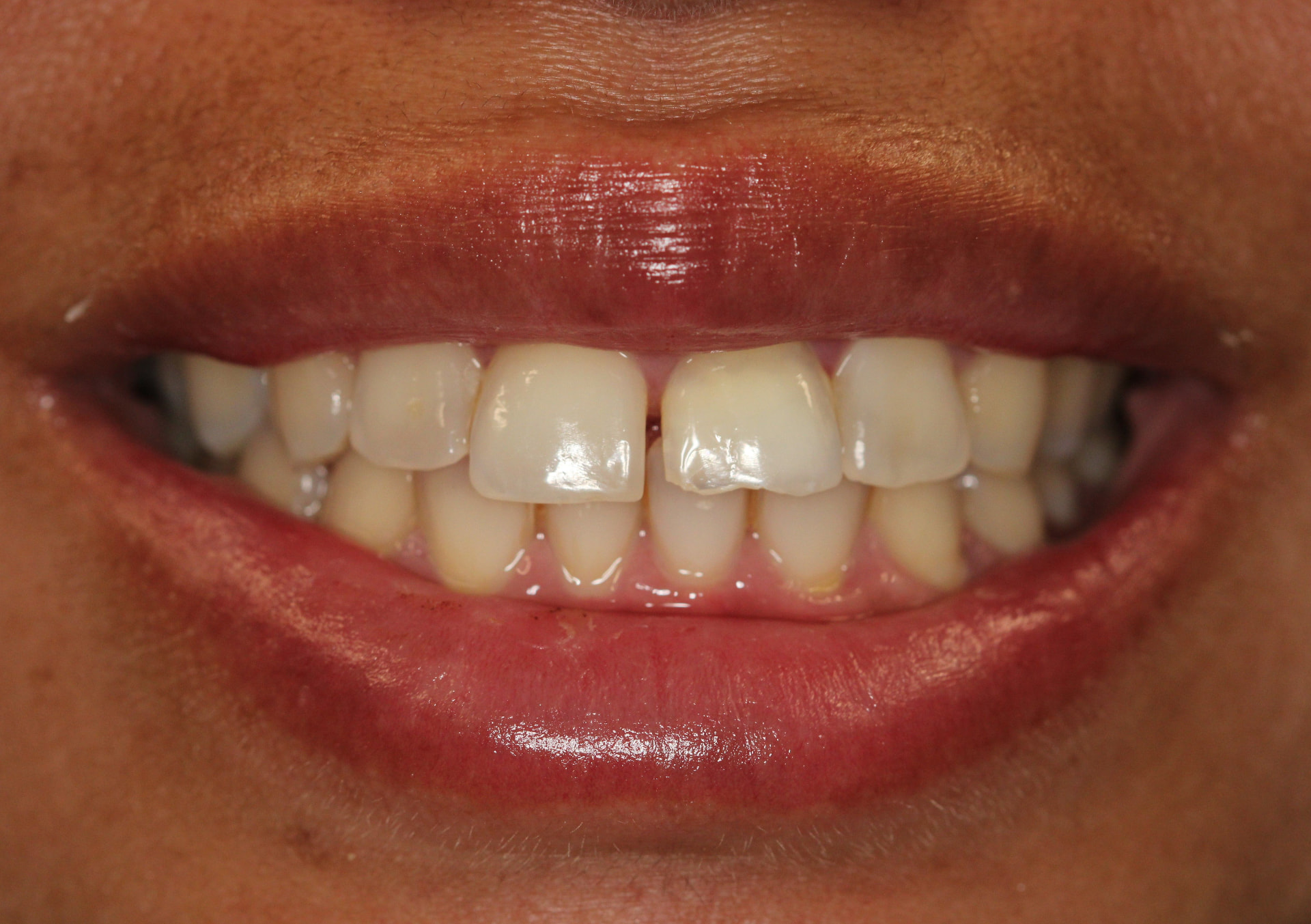 2 Upper Veneers before treatment