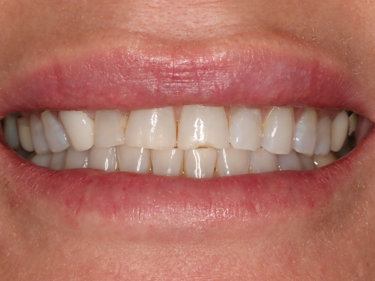 Upper and Lower Veneers before treatment