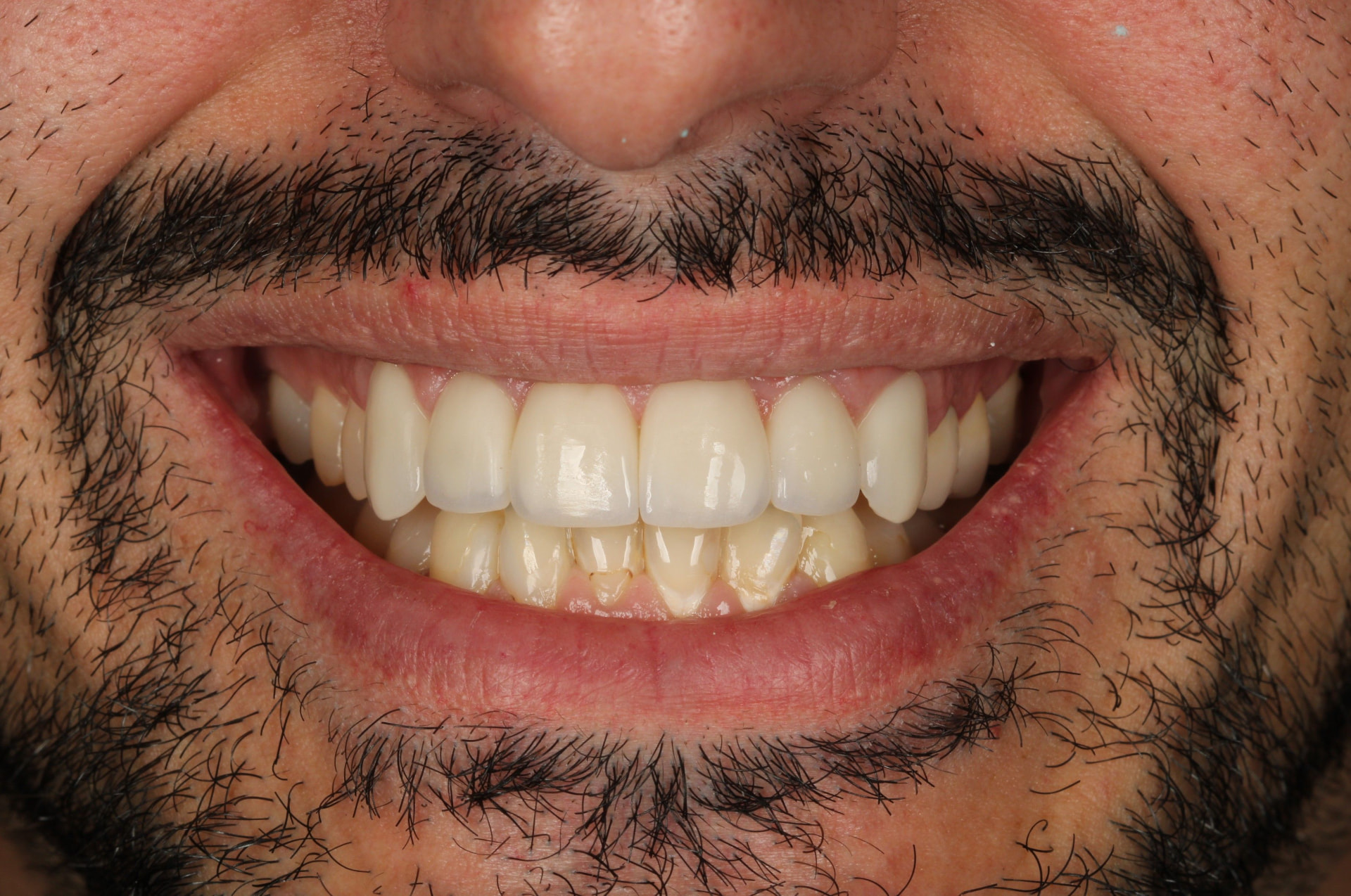 6 Upper Veneers after treatment