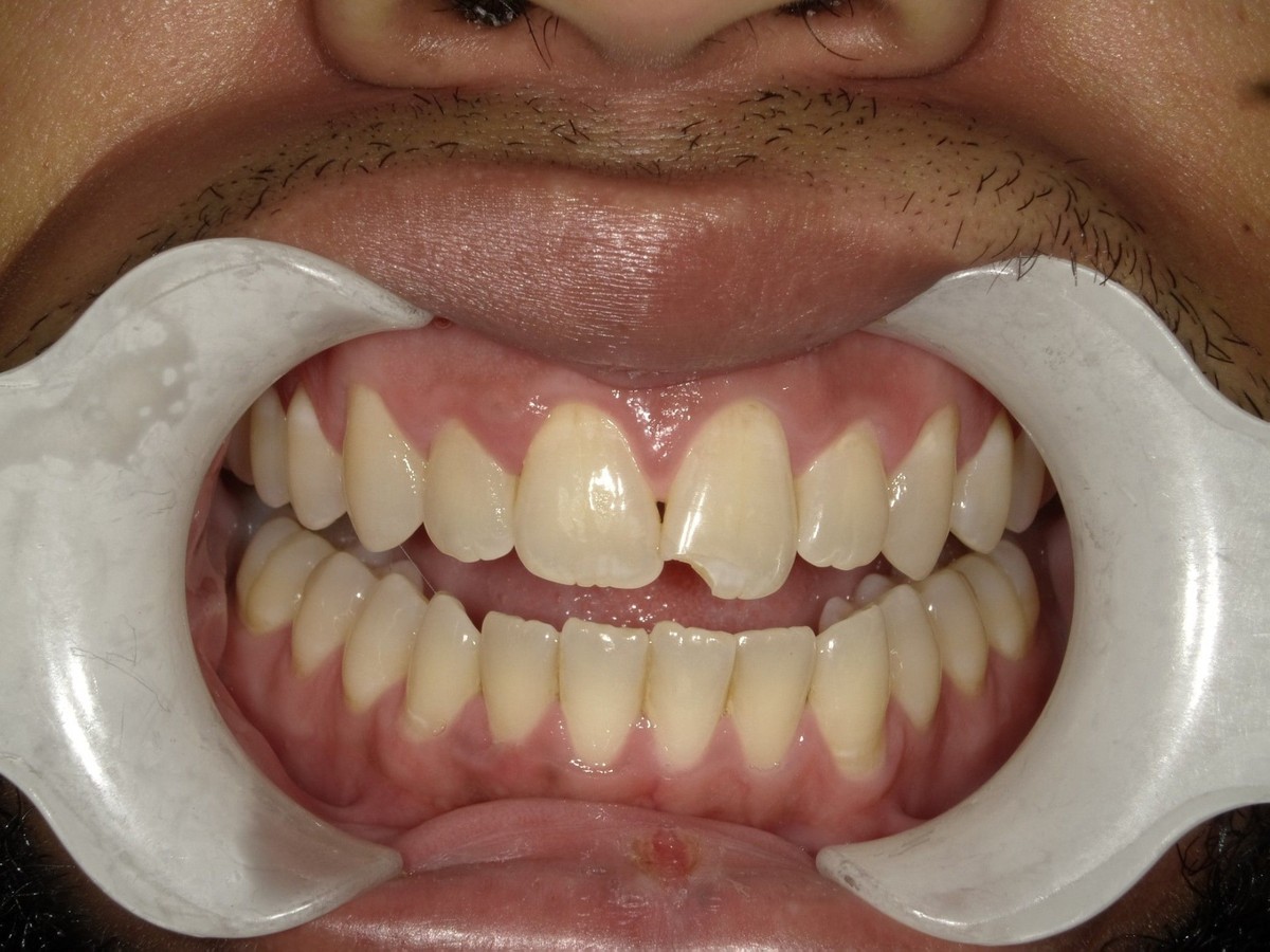 Cosmetic Bonding after treatment