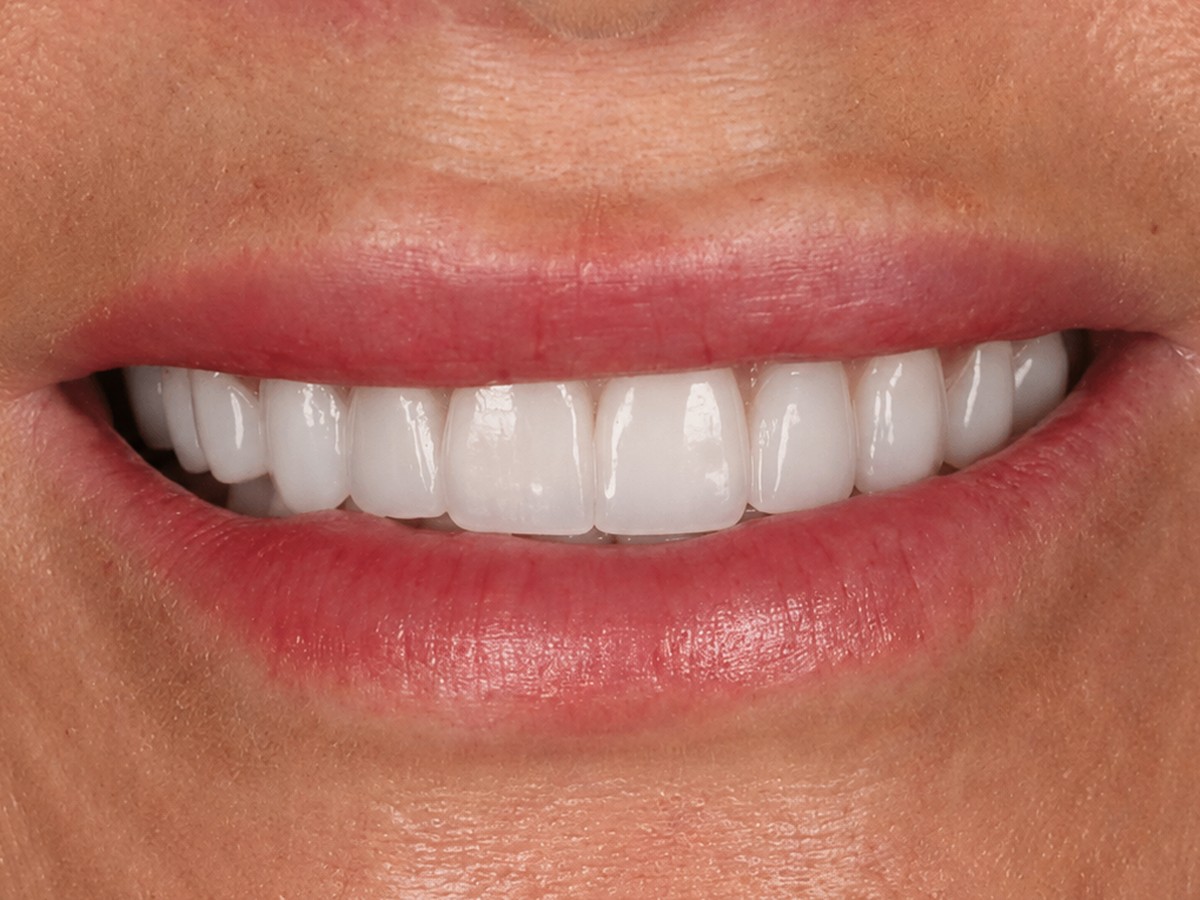 Upper and Lower Veneers after treatment