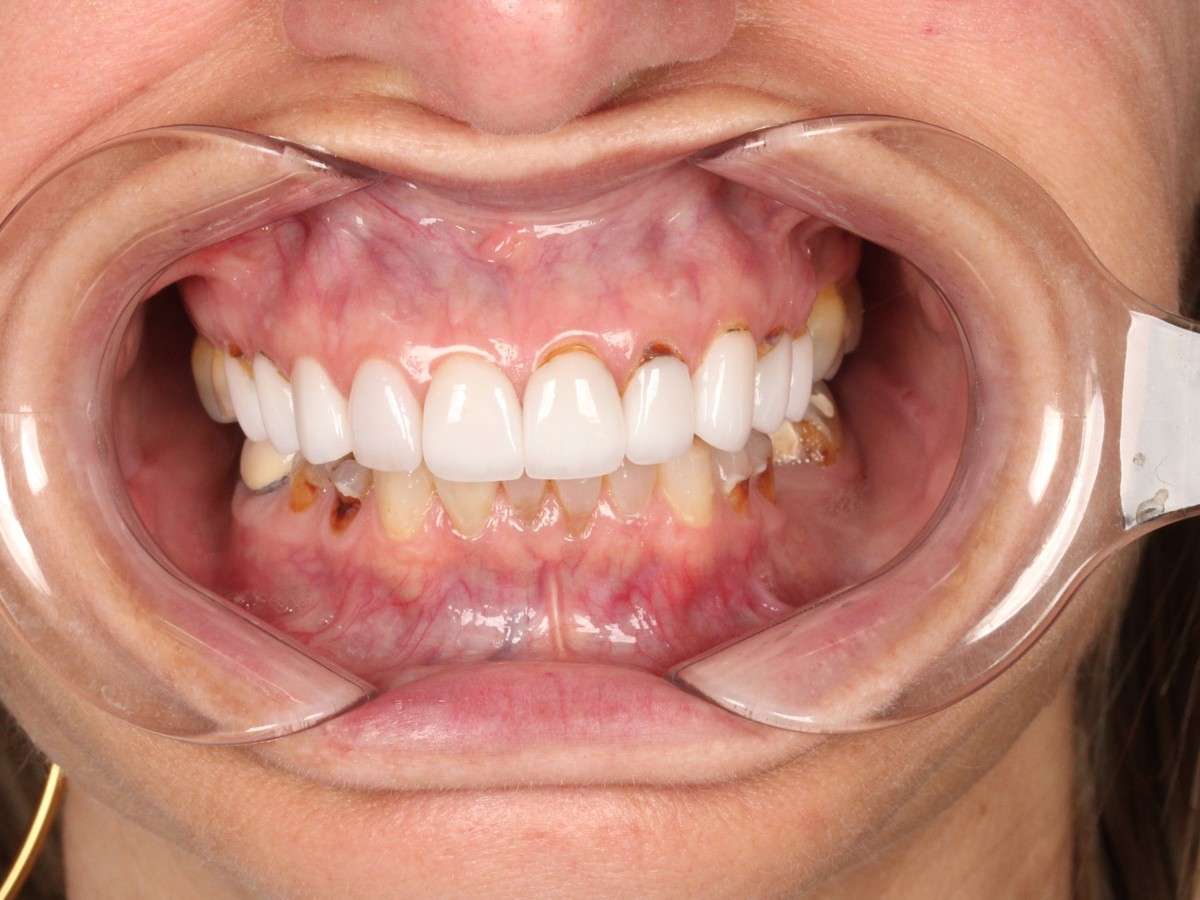 Full Arch Restoration before treatment