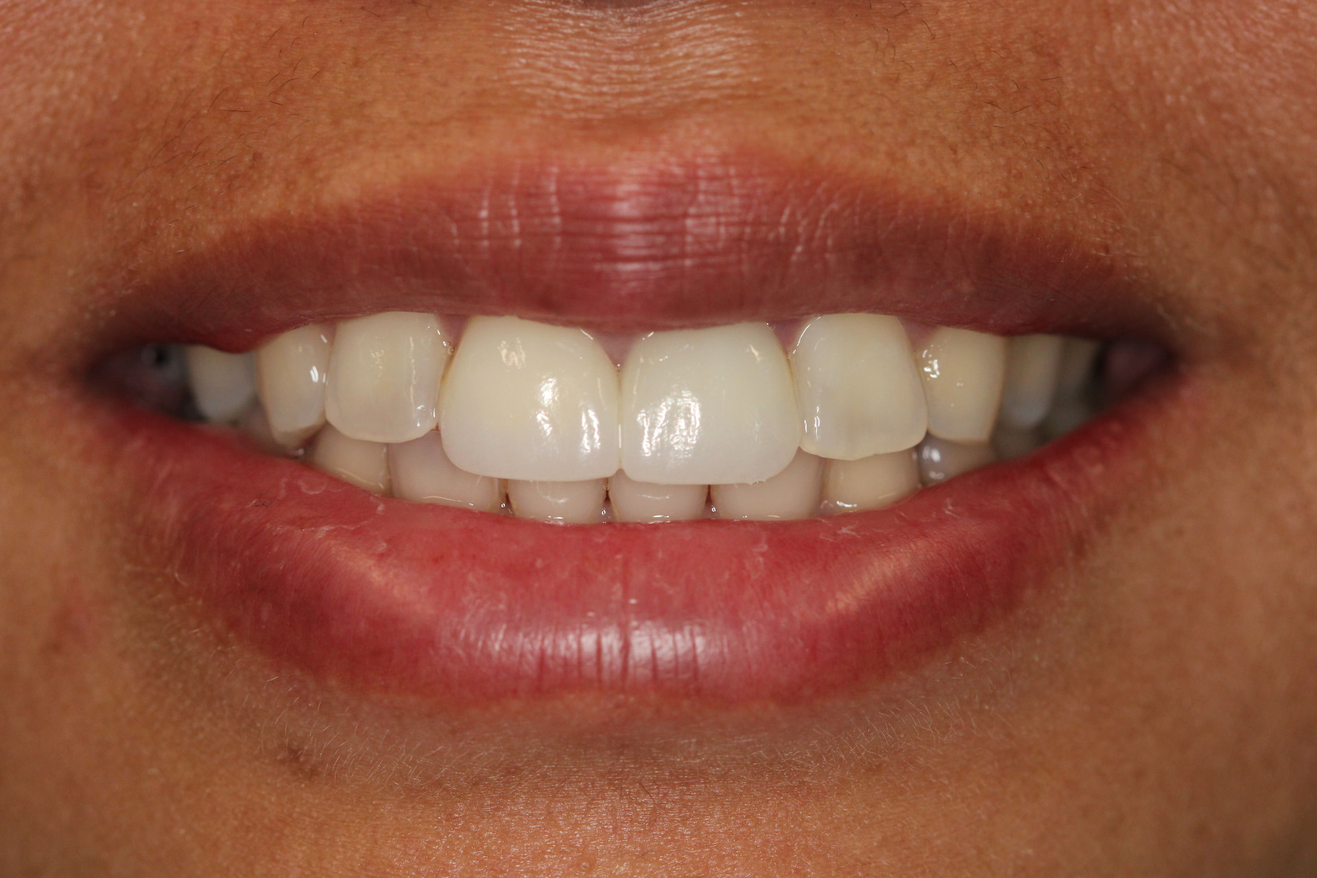 2 Upper Veneers after treatment